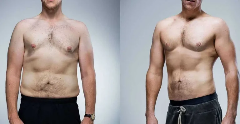 نحت الجسم بدون جراحة